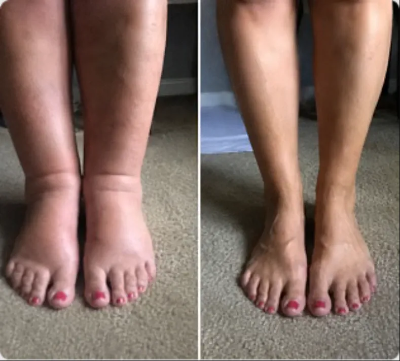 Sandra T. before and after