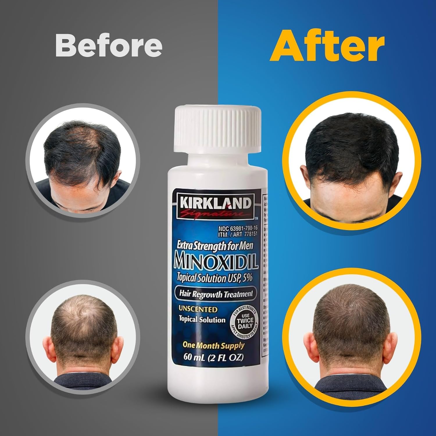 Minoxidil-5% Extra Strength Hair Regrowth for Men, 6 Month Supply