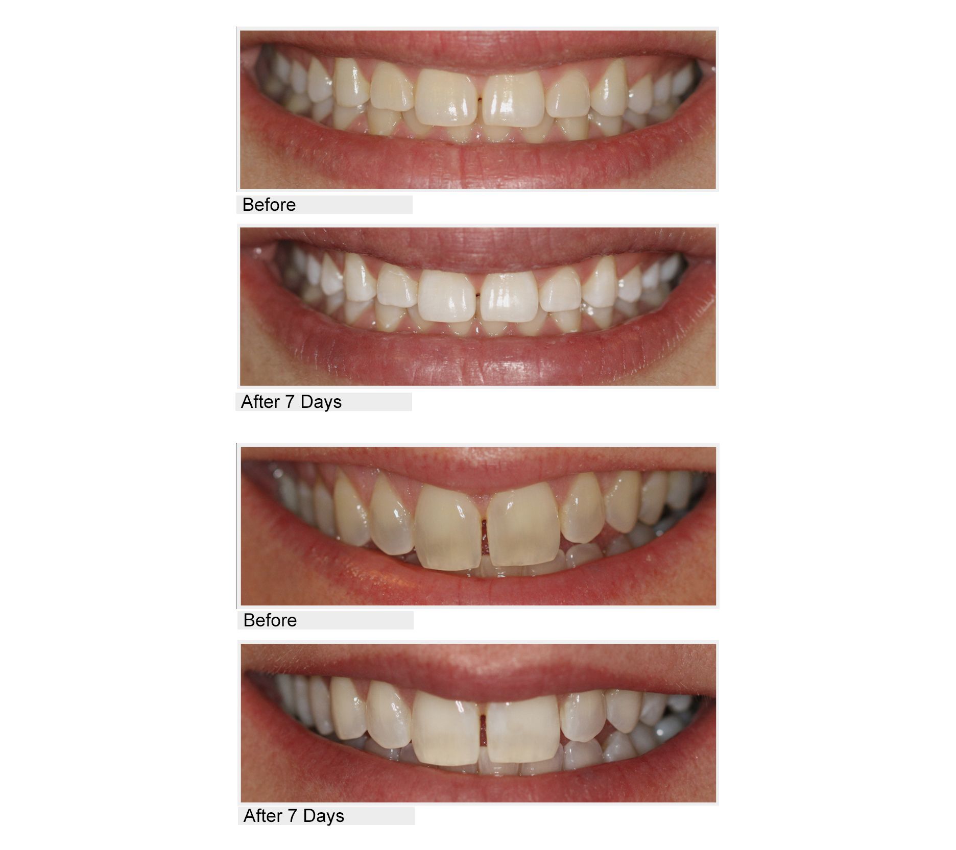 Smileactives CIJ Set of 5 Teeth Whitening Pens