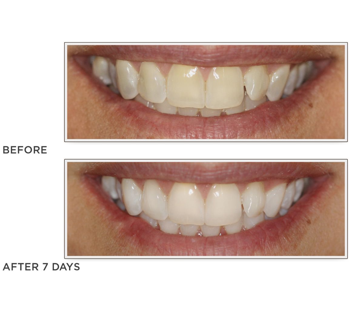 Smileactives Set of 3 Teeth Whitening Pens