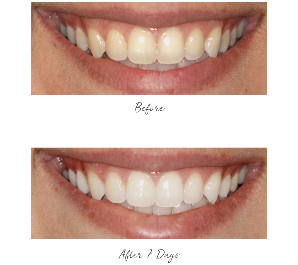 Smileactives Advanced Whitening Pens Duo