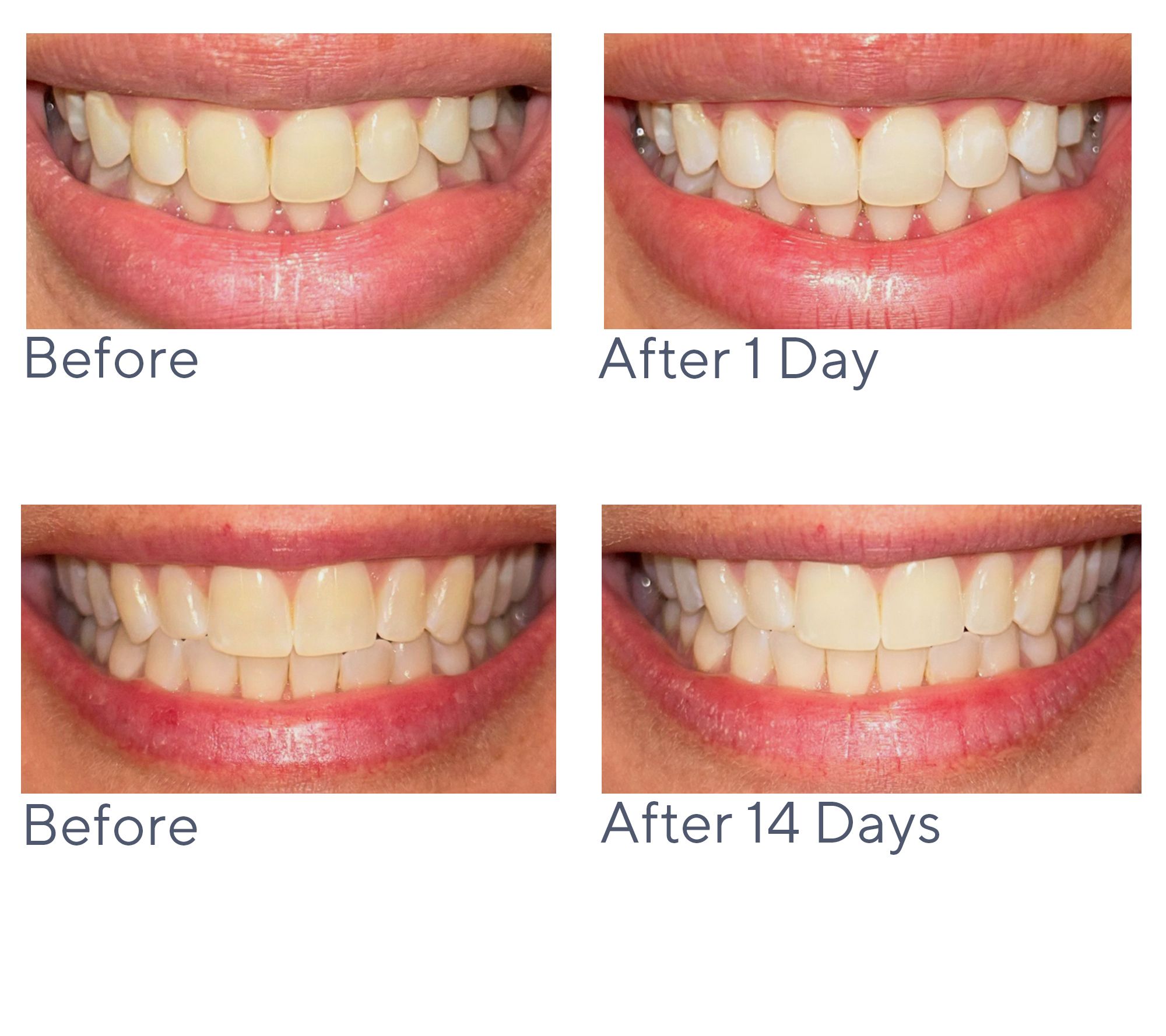 Smileactives Pro Teeth Whitening Gels Holiday Set Auto-Delivery