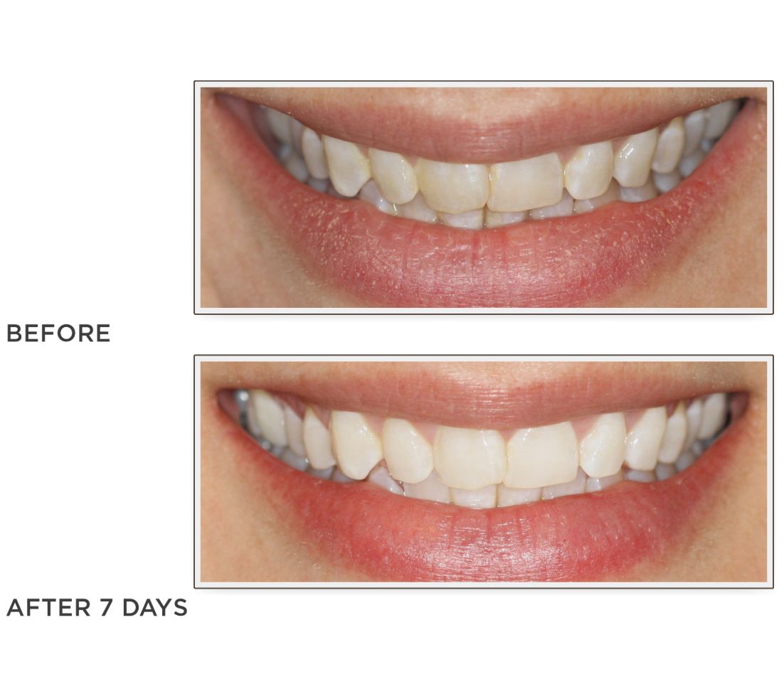 Smileactives Set of 3 Teeth Whitening Pens