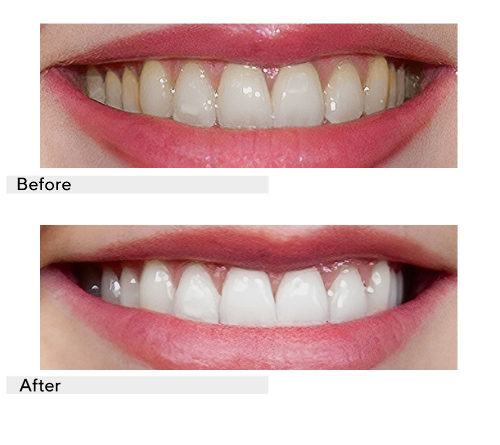 Supersmile Teeth Whitening Home & Away 6-pc System with Travel Bag