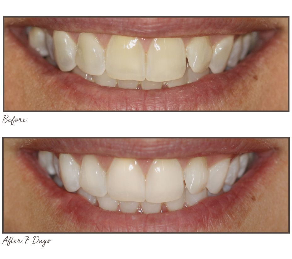 Smileactives CIJ Set of 5 Teeth Whitening Pens