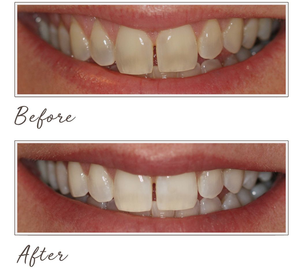 Smileactives Advanced Teeth Whitening Pen Trio