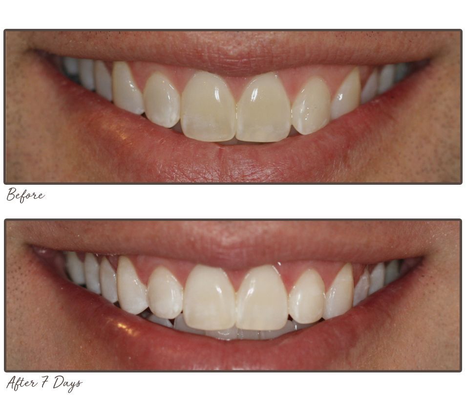 Smileactives CIJ Set of 5 Teeth Whitening Pens