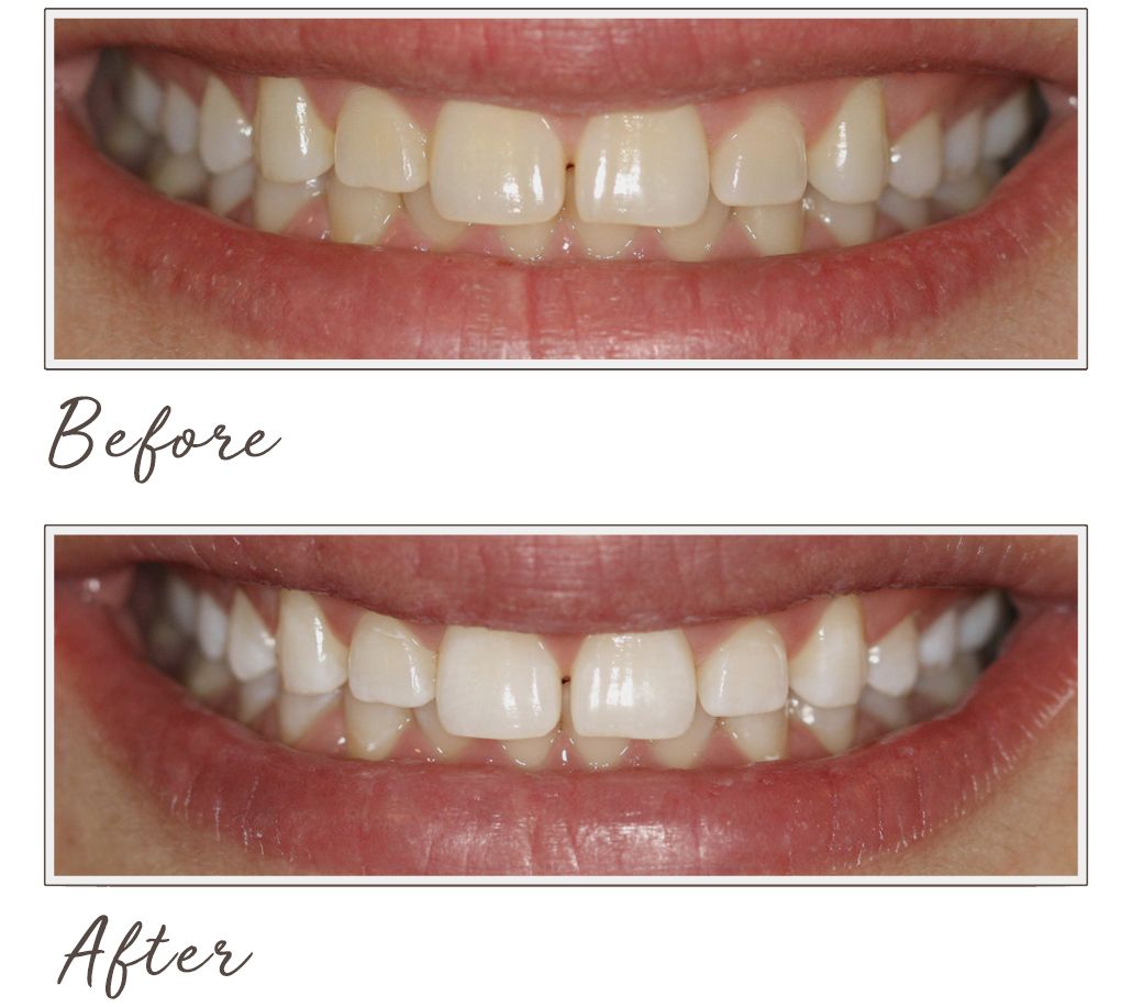 Smileactives Advanced Teeth Whitening Pen Trio