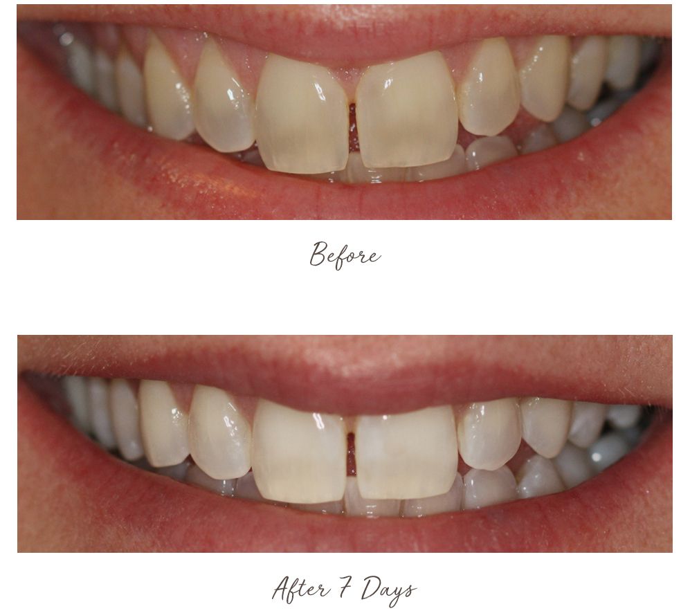 Smileactives Advanced Whitening Pens Duo