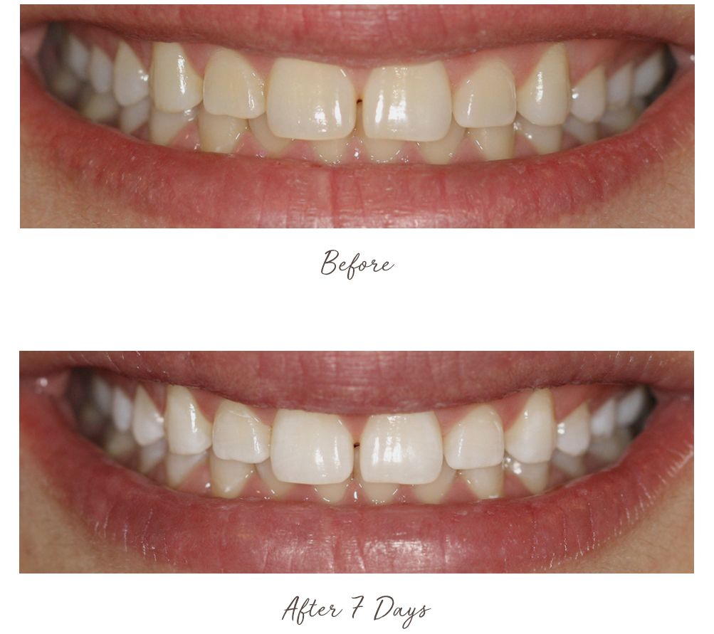 Smileactives Advanced Whitening Pens Duo