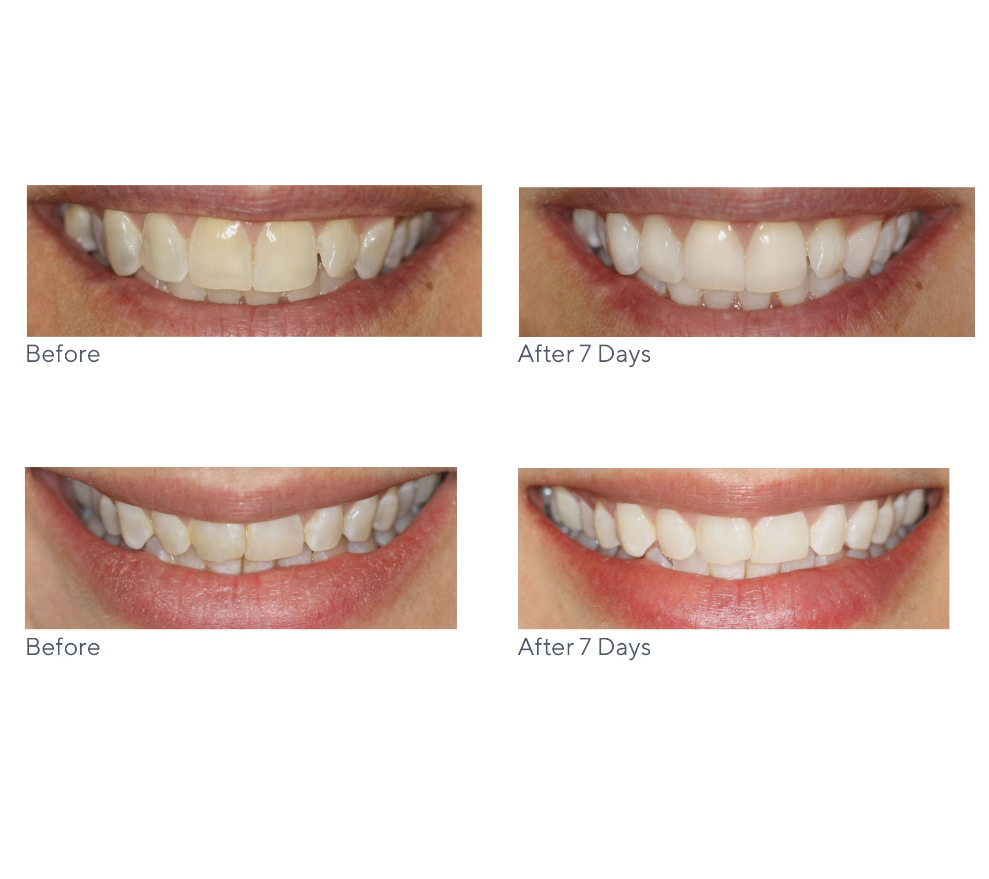 Smileactives Set of 3 Whitening Pens Auto-Delivery