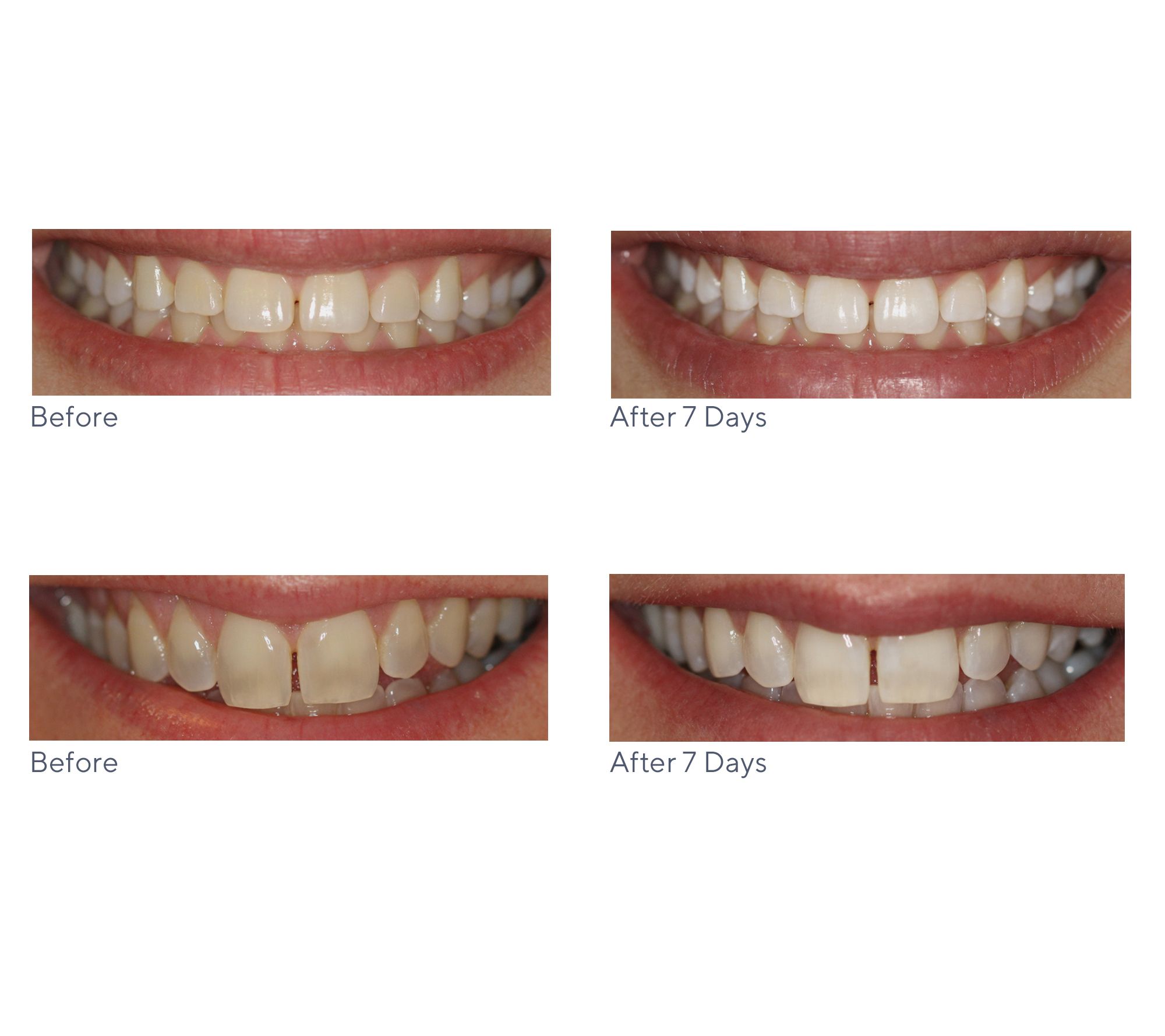 Smileactives Set of 5 Teeth Whitening Pens