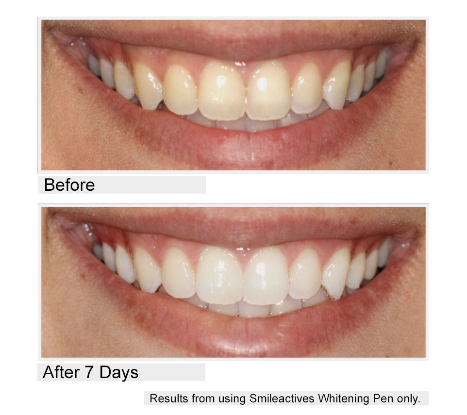 Smileactives CIJ Set of 5 Teeth Whitening Pens