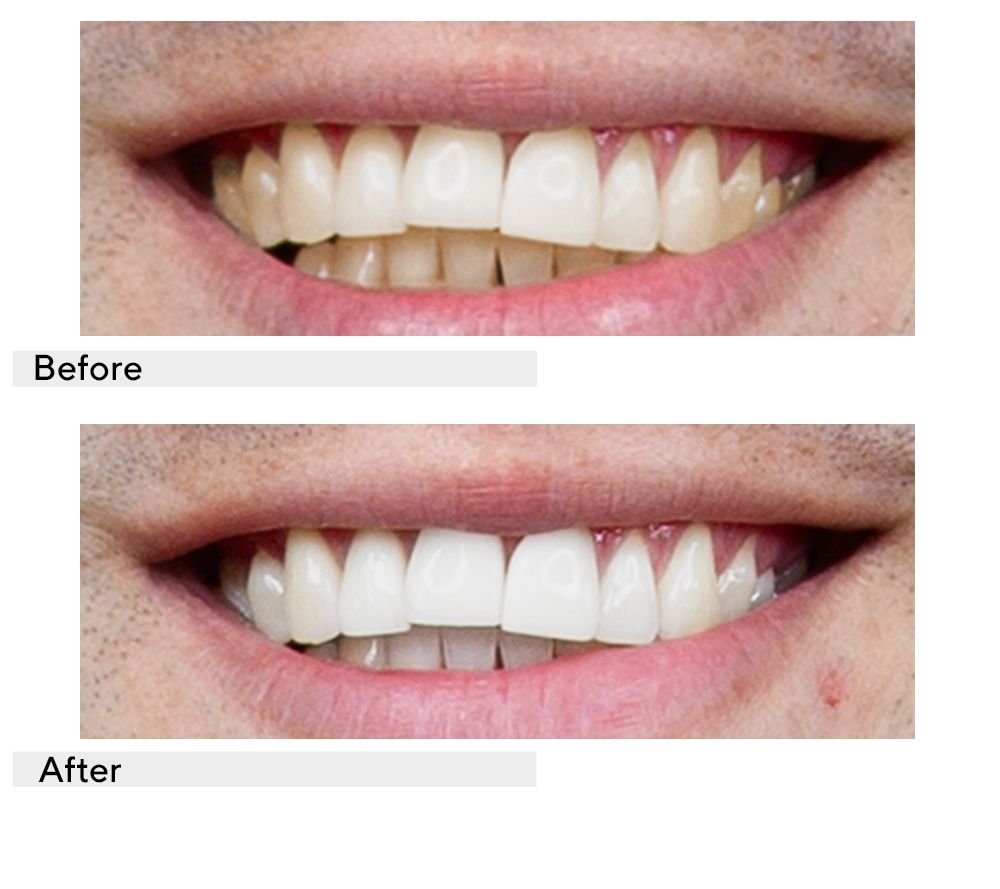 Supersmile Teeth Whitening Home & Away 6-pc System with Travel Bag