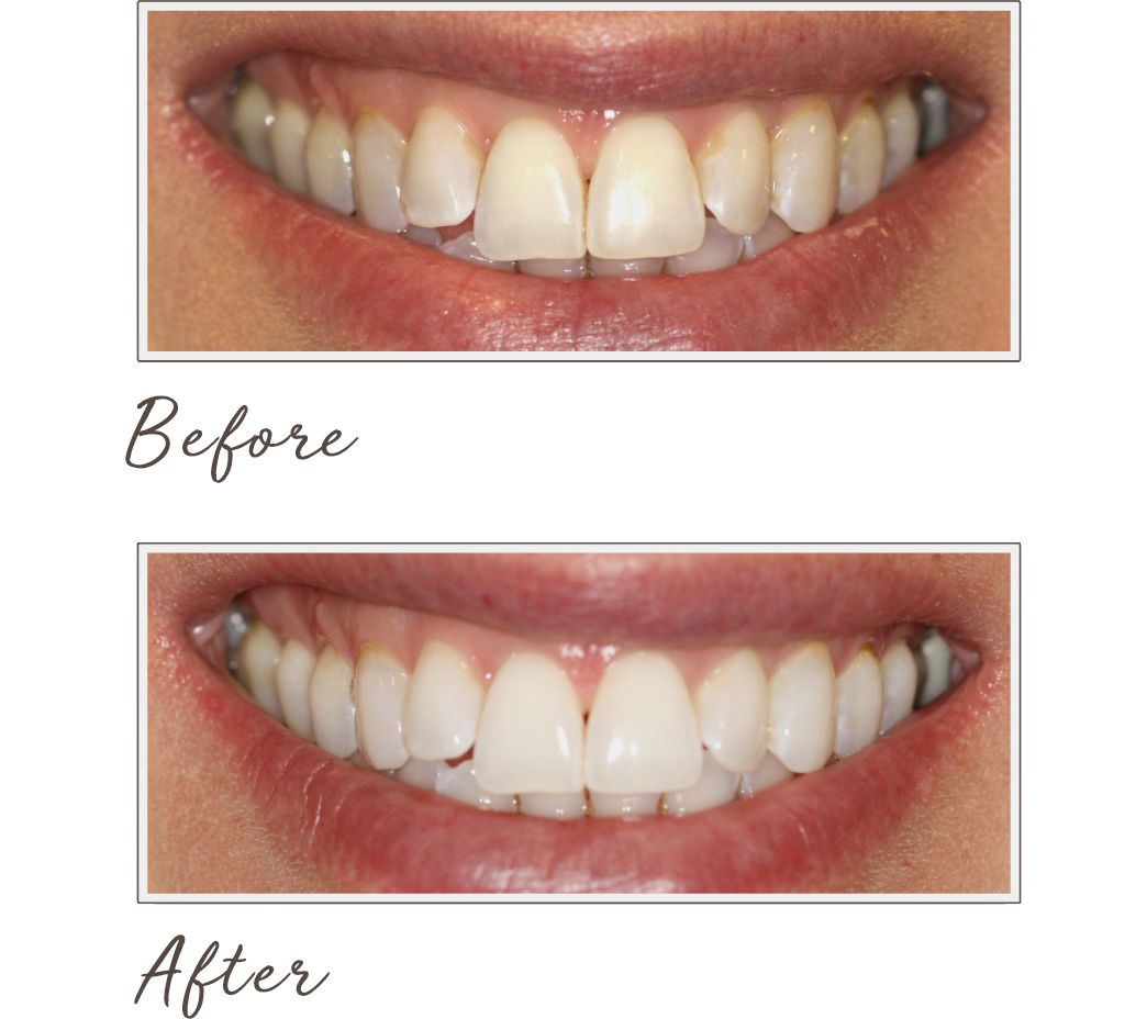 Smileactives Advanced Teeth Whitening Pen Trio