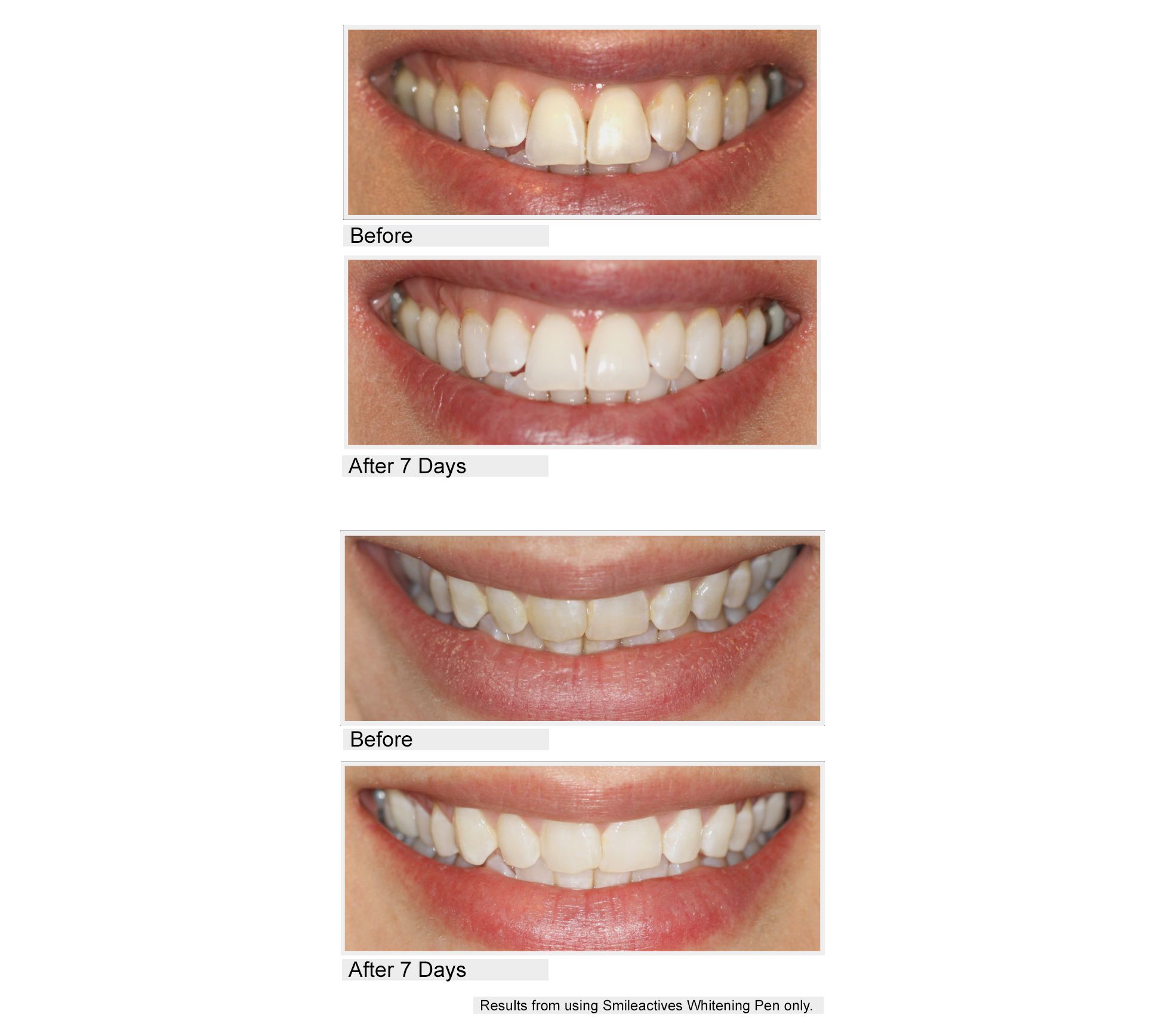 Smileactives CIJ Set of 5 Teeth Whitening Pens