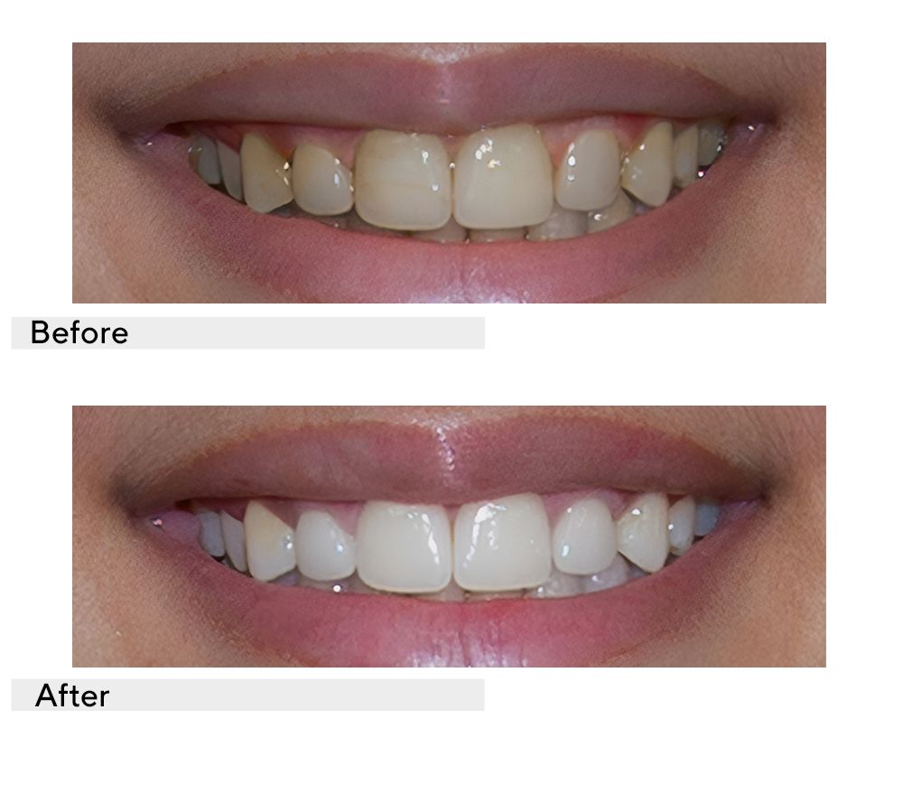 Supersmile Teeth Whitening Home & Away 6-pc System with Travel Bag