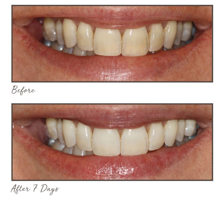 Smileactives CIJ Set of 5 Teeth Whitening Pens