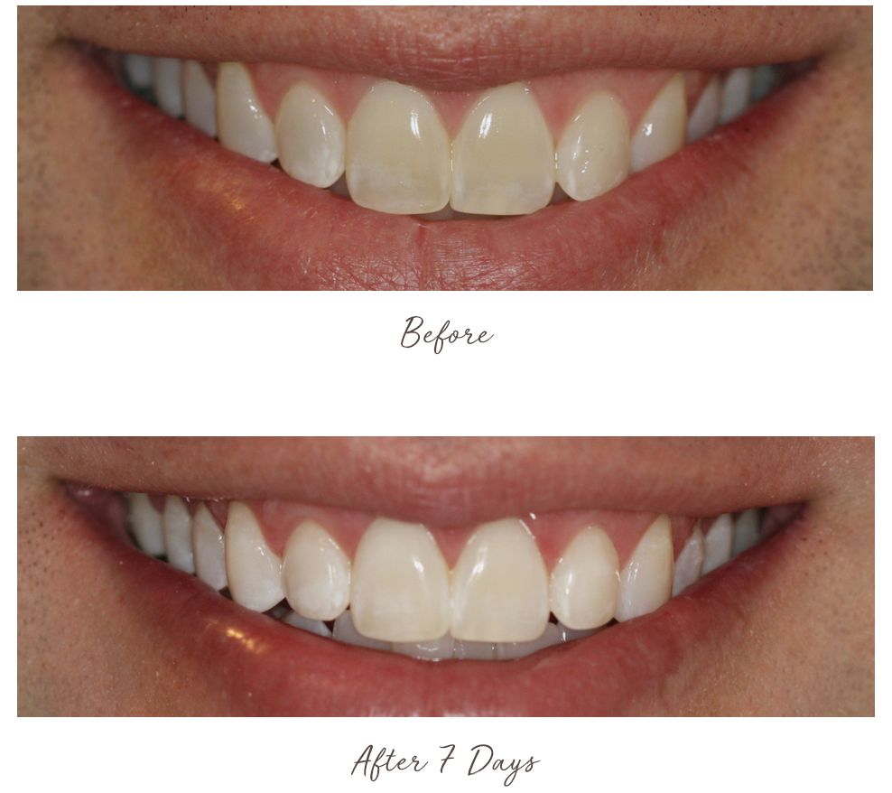 Smileactives Advanced Whitening Pens Duo