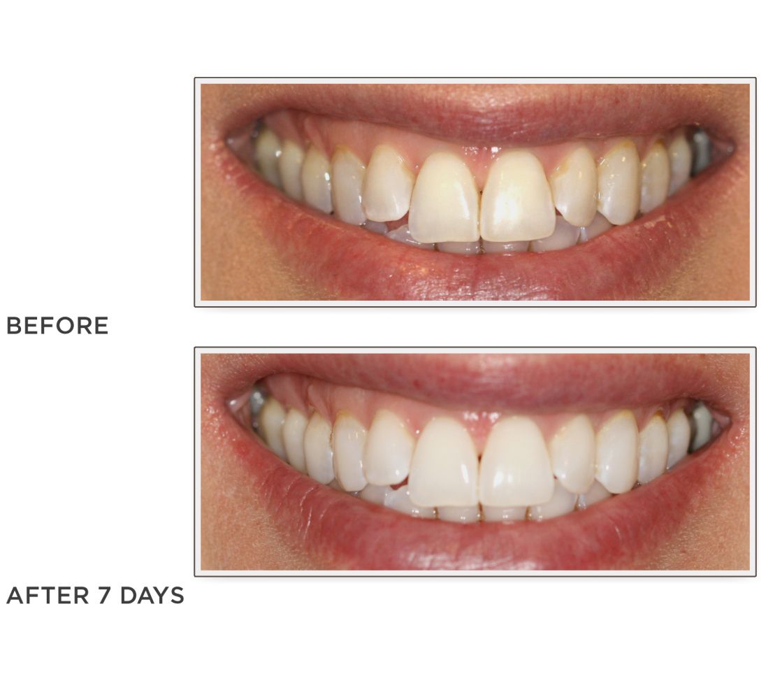 Smileactives Set of 3 Teeth Whitening Pens