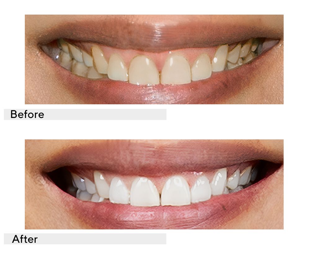 Supersmile Teeth Whitening Home & Away 6-pc System with Travel Bag