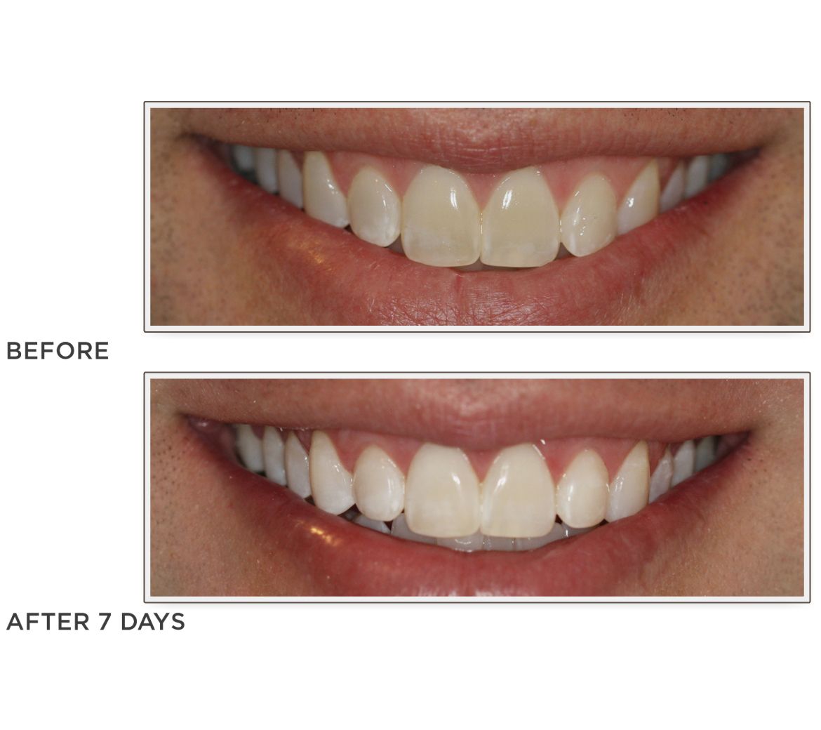 Smileactives Set of 3 Teeth Whitening Pens