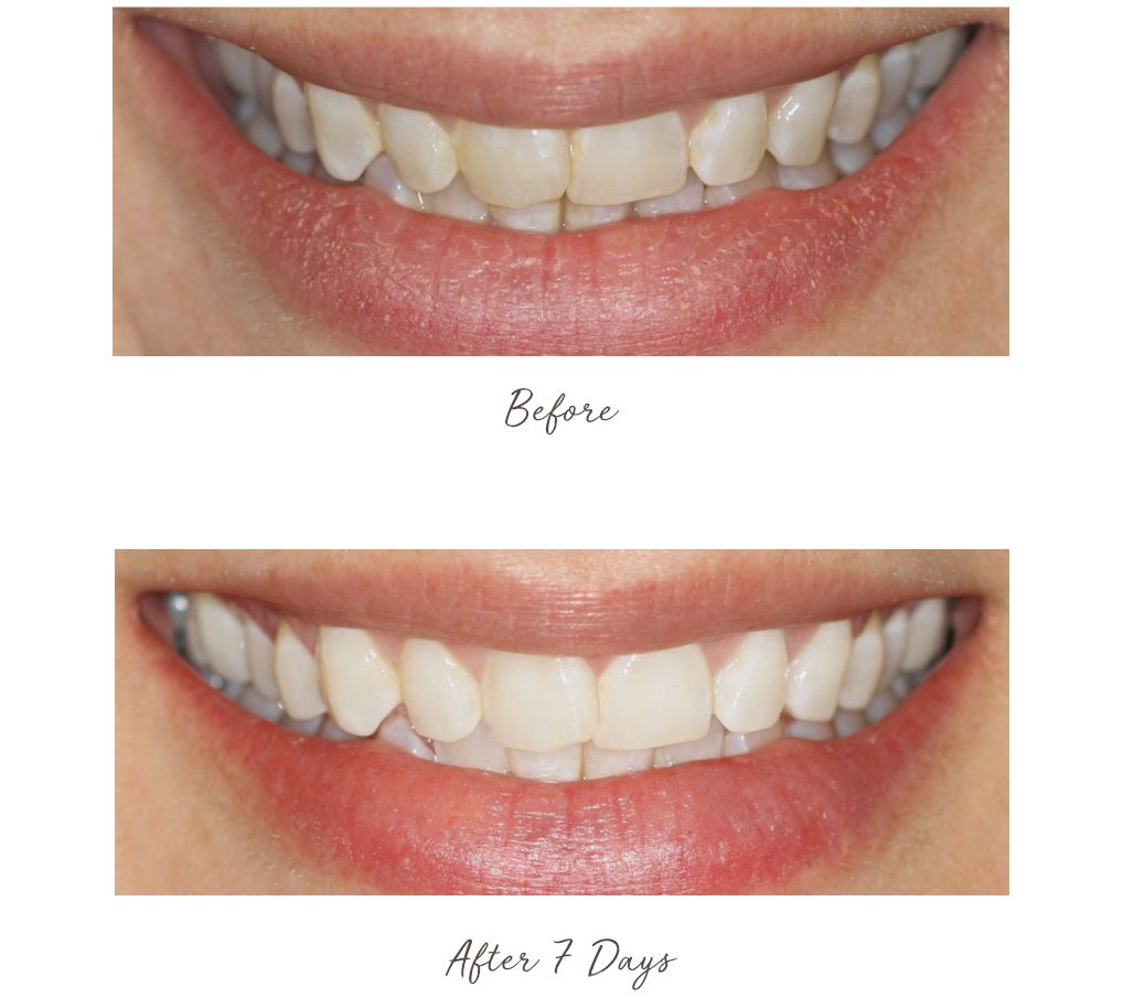 Smileactives Advanced Whitening Pens Duo