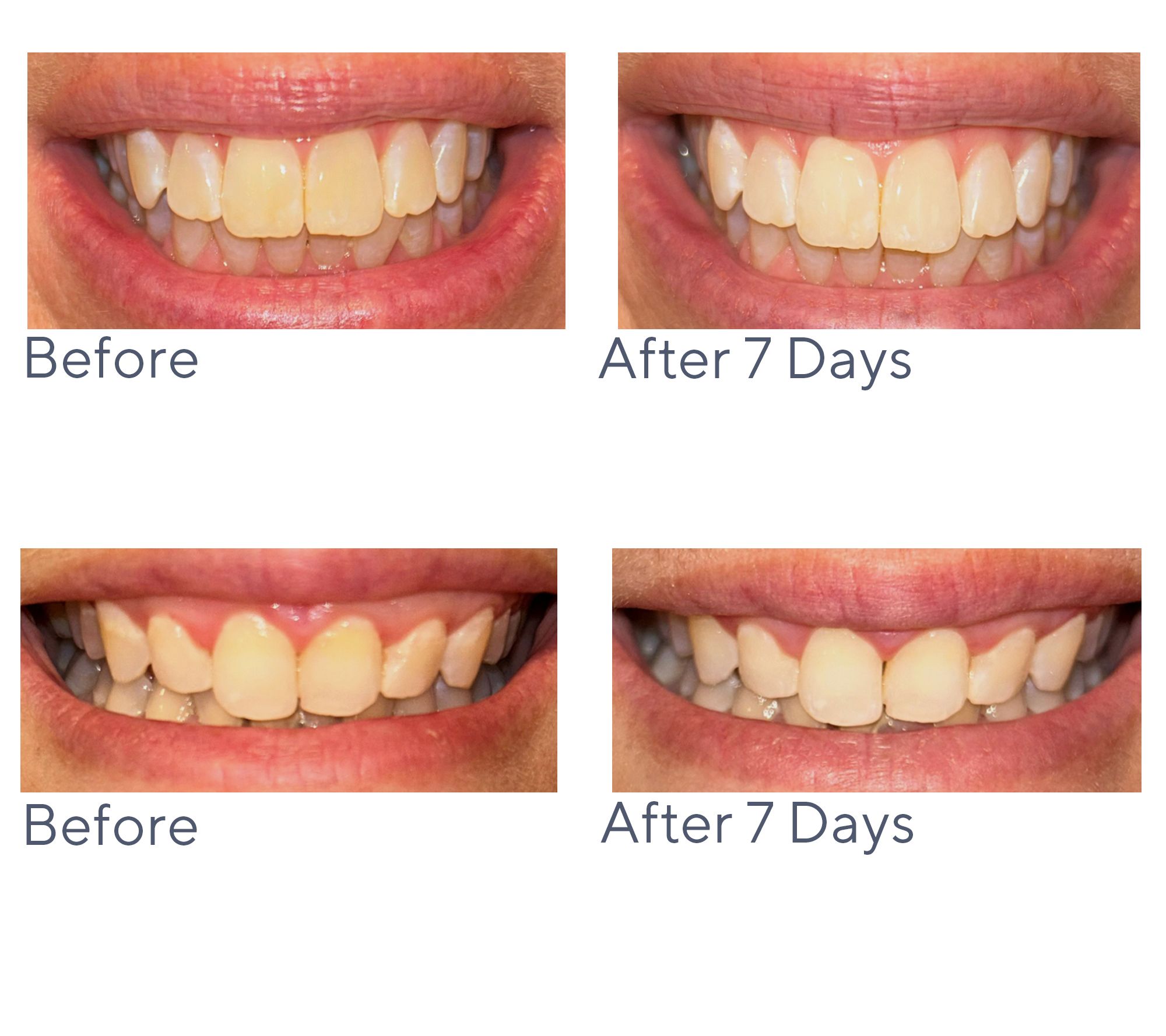 Smileactives Pro Teeth Whitening Gels Holiday Set Auto-Delivery